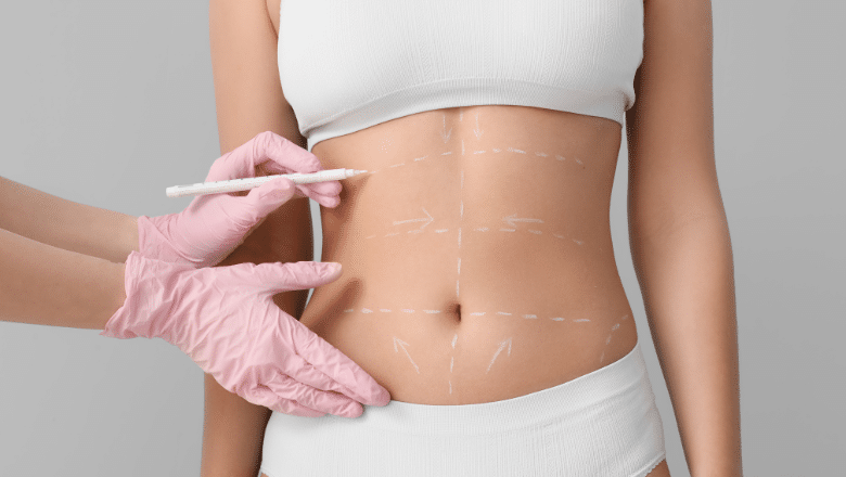 The Most Popular Liposuction Areas—And Why